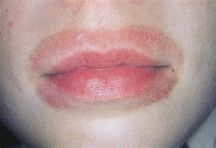 Lip dermatitis - How To Discuss